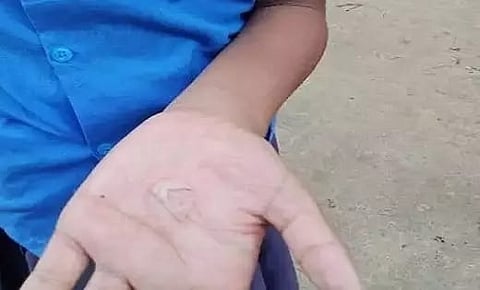 The enraged teacher reportedly burnt the hands of the school children with boiling oil, resulting in blisters.