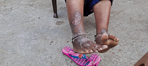 The impact of contaminated water persists in the region surrounding Union Carbide, a result of massive dumping of factory waste. Post the gas tragedy, residents suffer from diseases such as cancer, kidney ailments, skin infection and disabilities. 
