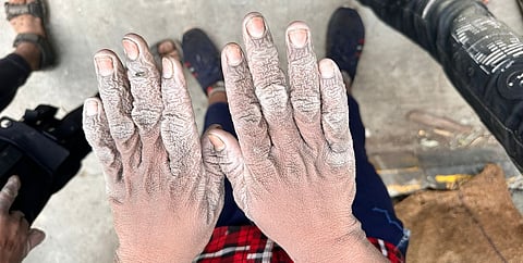 Child's hand burned by alcohol while working in a liquor factory.