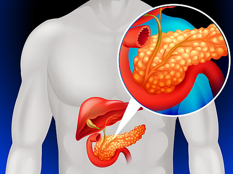 Battling a silent threat: How pancreatic cancer is rising in India and needs to be treated