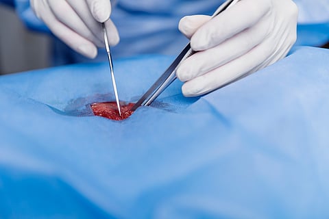 Transforming Lives Through Bone Marrow Transplantation