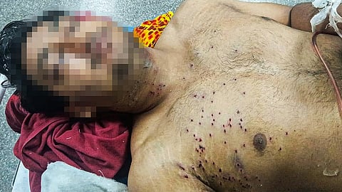 Fourth pellet-like injury victim at July 20 march: 22-yr-old is Delhi Police aspirant