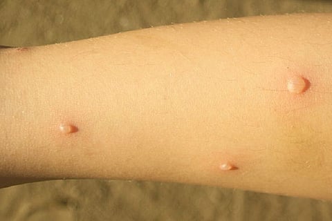 Everything you need to know about chickenpox and why more countries don’t use the vaccine