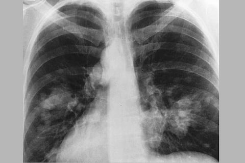 Lung cancer in non-smokers on the rise: what does this mean? 