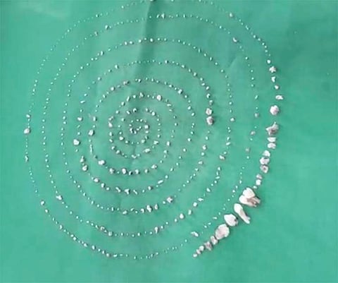 In rare surgery, Chennai doctors extract 526 teeth from 7-year-old's mouth