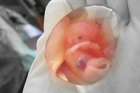 Why 10 million Indian women secretly undergo abortions every year