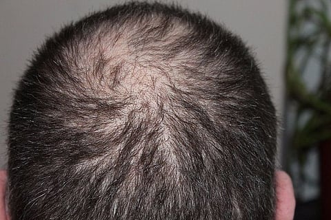 Why short, fair men go bald prematurely