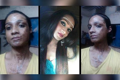 Hope for Sonia: Gang raped and attacked with acid, court orders compensation for trans woman 