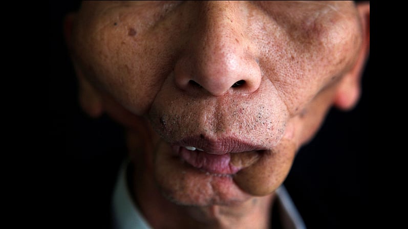 A patient of mouth cancer after brutal rounds of chemotherapy. It’s still your right to smoke and dirty up your lungs (Photo courtesy: Voice of Tobacco Victims)