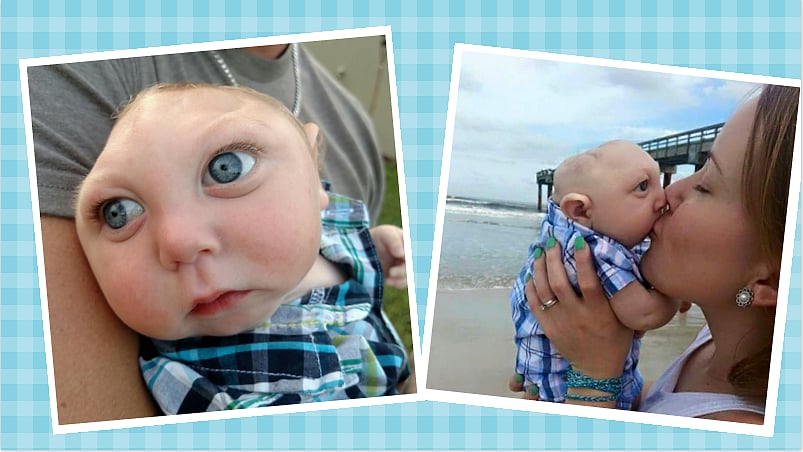 Jaxon Emmett Buell is a medical miracle, he’s seeing the world with half a skull (Photo courtesy: <a href="https://www.facebook.com/WeAreJaxonStrong">Jaxon Strong/ Facebook</a>)