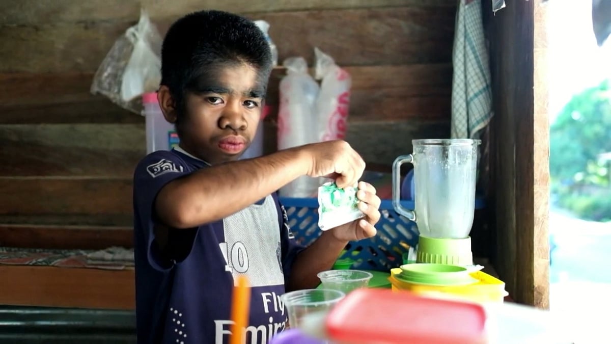Muhammad Raihan, 13, has a rare genetic condition called the Werewolf Syndrome. (Photo: AP screengrab)