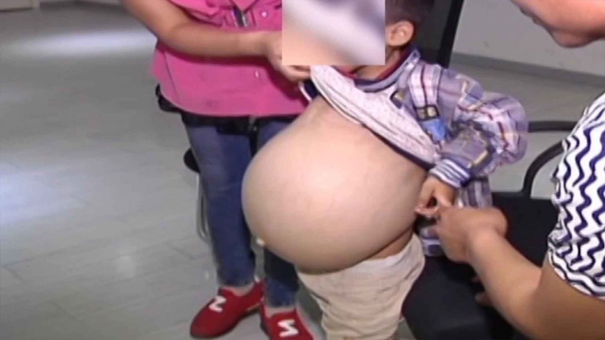 The six-year-old boy who suffers from a benign tumor. (Photo: AP Screengrab)