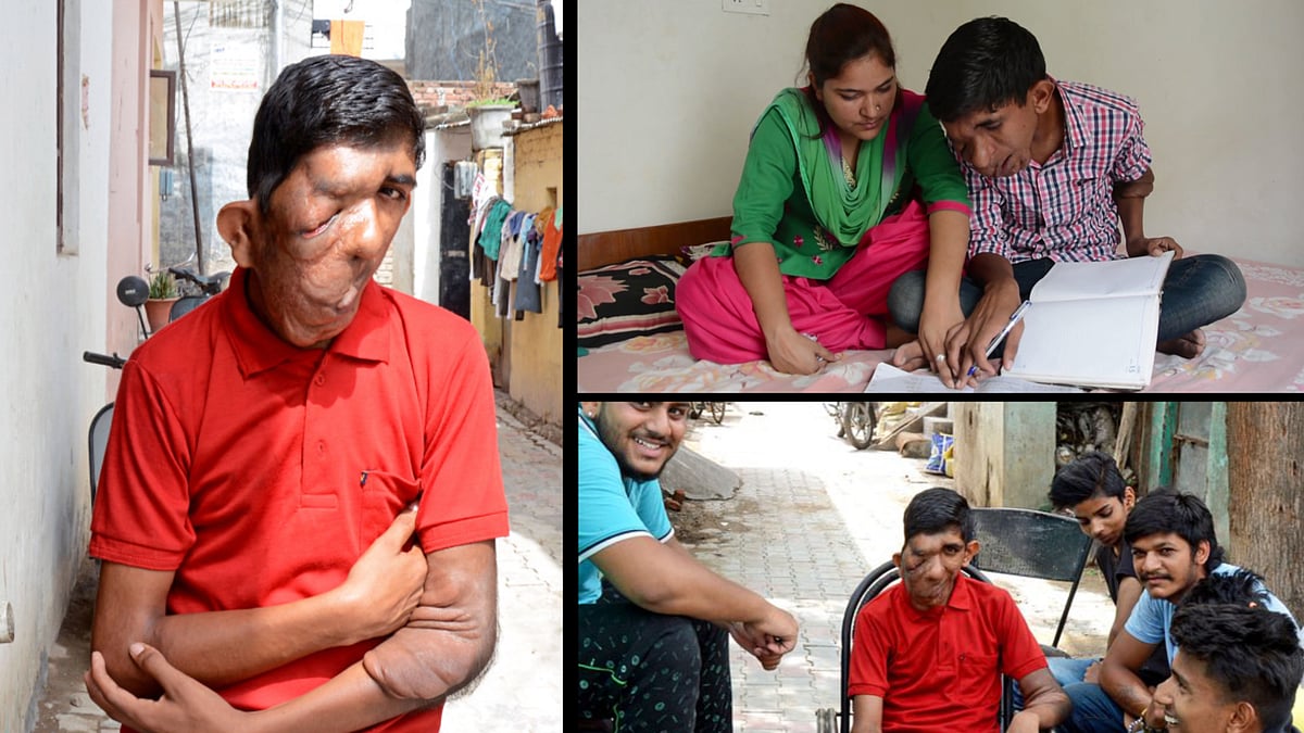 Indian teenager Bhupinder Singh from Chandigarh is suffering from neurofibromatosis - a rare condition that has left him with a drooping face. (Photo: AP/Caters News screengrab)