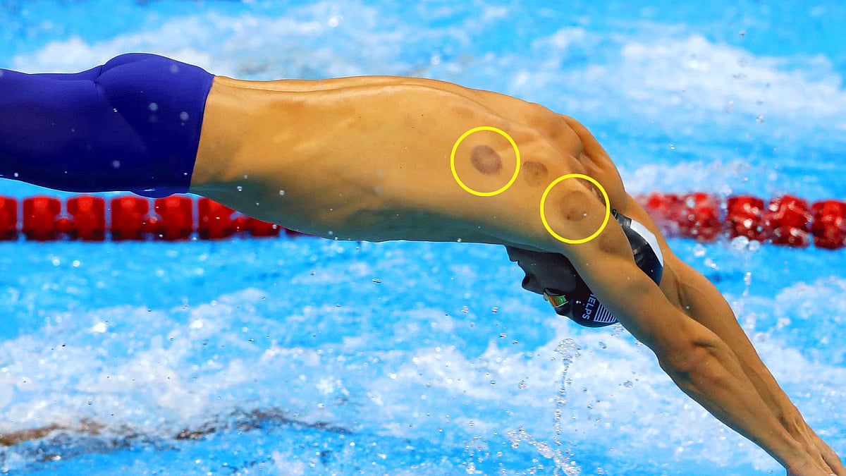 Is this ancient practice of healing sore muscles and improving circulation trick or treatment? (Photo courtesy: AFP)