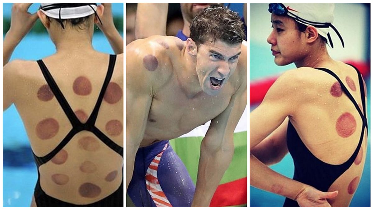 Athletes photographed with red marks all over their body. (Photo Courtesy: Instagram/<a href="https://www.instagram.com/p/BI2vRu_A5cI/?tagged=michaelphelps">weix105437</a>)