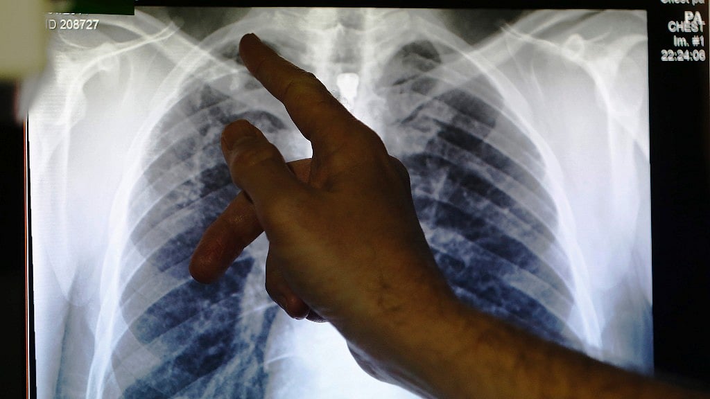 An 18-year-old girl is fighting not only a war against a strain of drug-resistant TB, but also a legal battle to obtain a strictly regulated new medicine that could save her life. (Photo: Reuters)