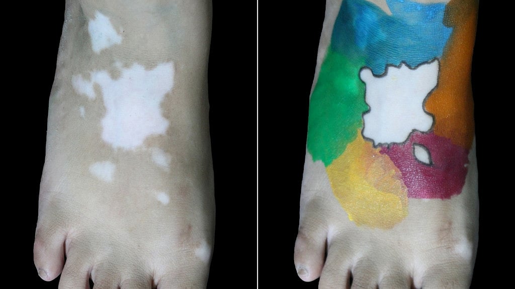 1 percent of the world’s population has vitiligo, a condition that causes loss of skin colour.