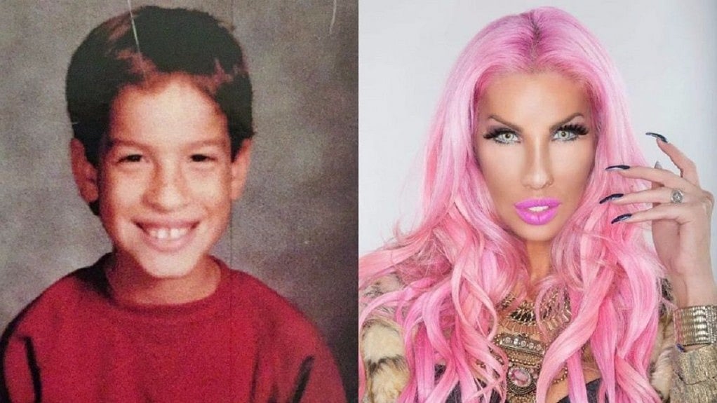 Nikki Exotica before and after surgery.