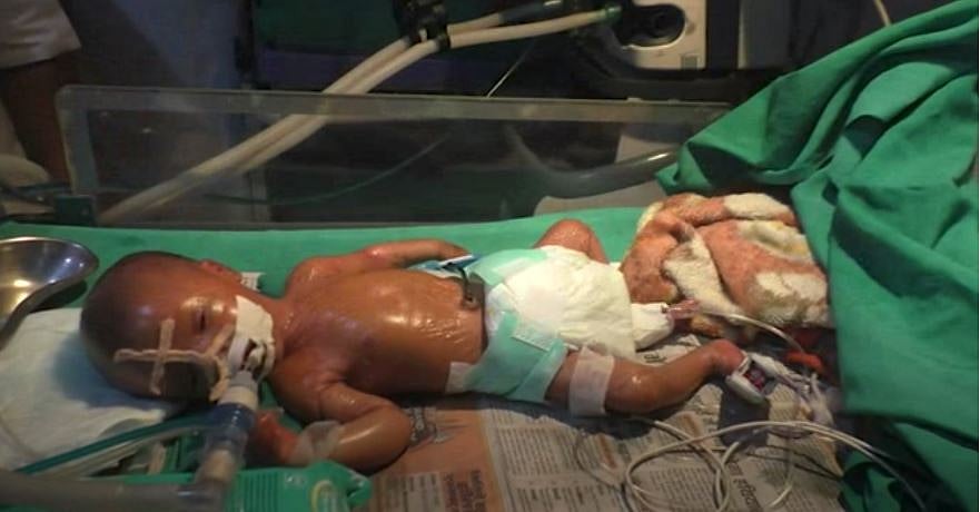 An infant in UP’s Balrampur, is born with lamellar ichthyosis that makes his skin ‘plastic-like’