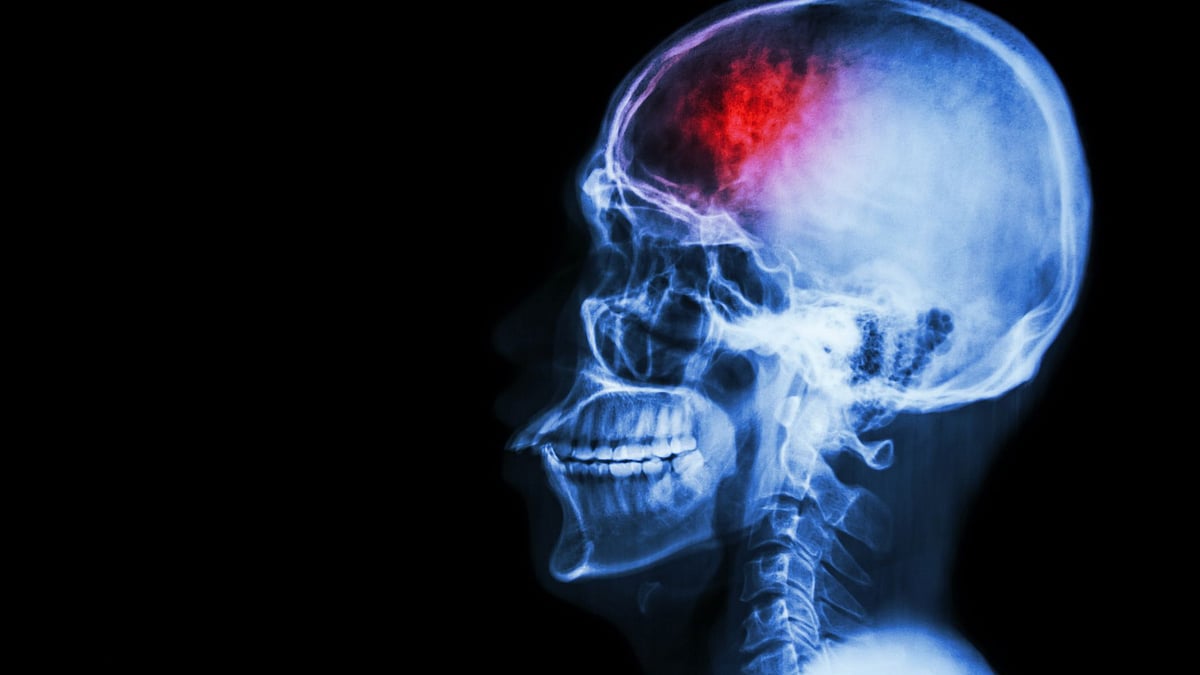 According to the World Stroke Organisation, 1 in 6 people in the world will suffer a stroke in their lifetime.