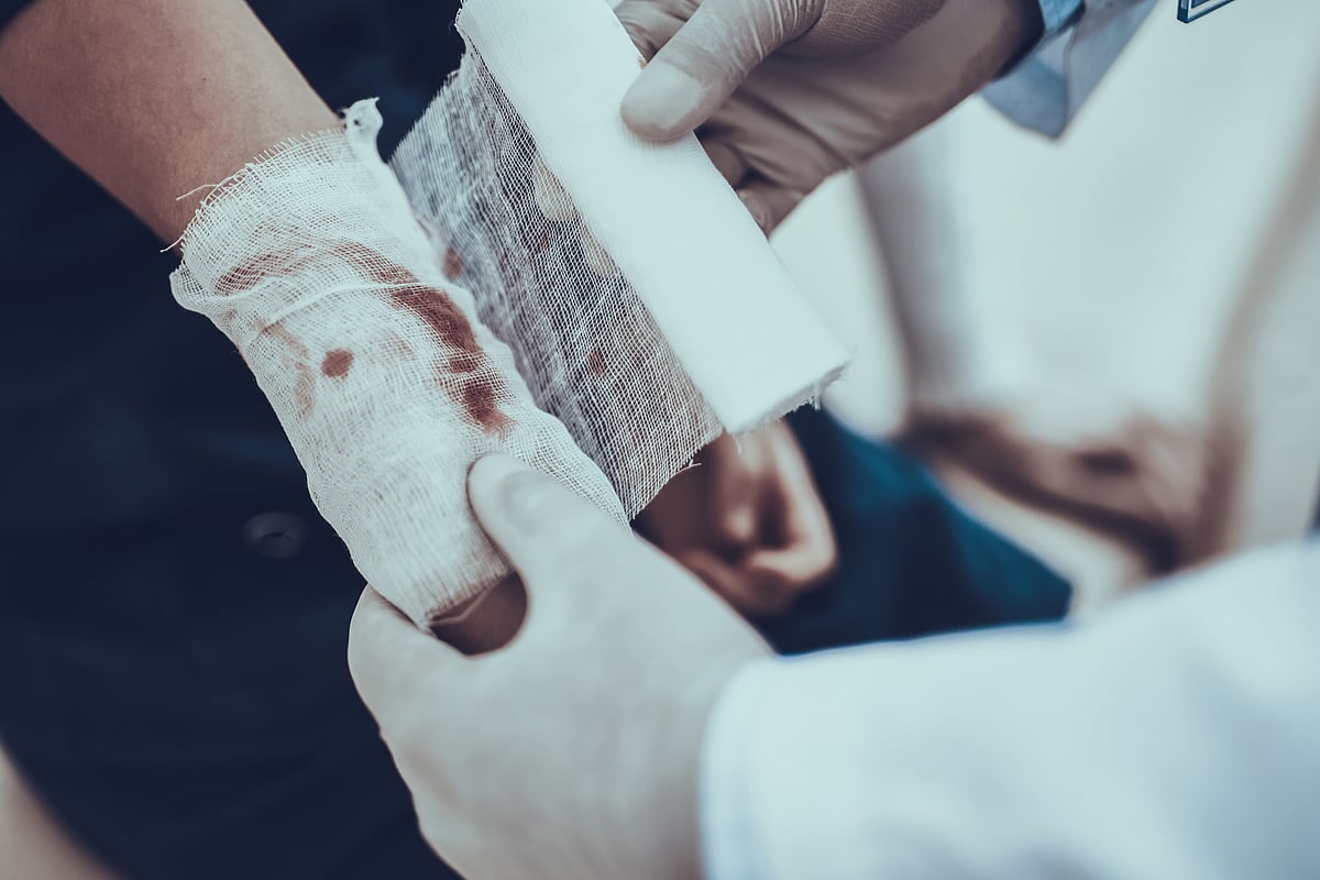 The health ministry recognises that more people die due to burns injuries in India than due to malaria and tuberculosis.