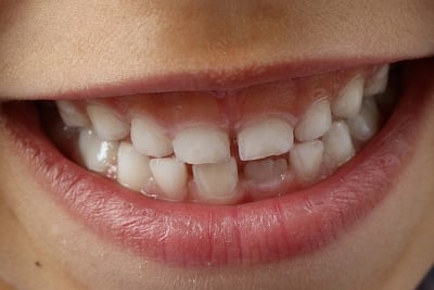 Teeth.