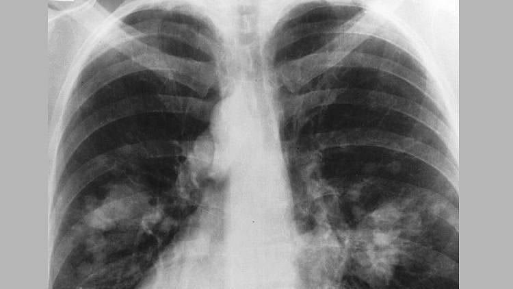 In what is seen as a widening of its testing criteria, the Union Ministry of Health on Friday stated pneumonia patients will also be tested for COVID-19.