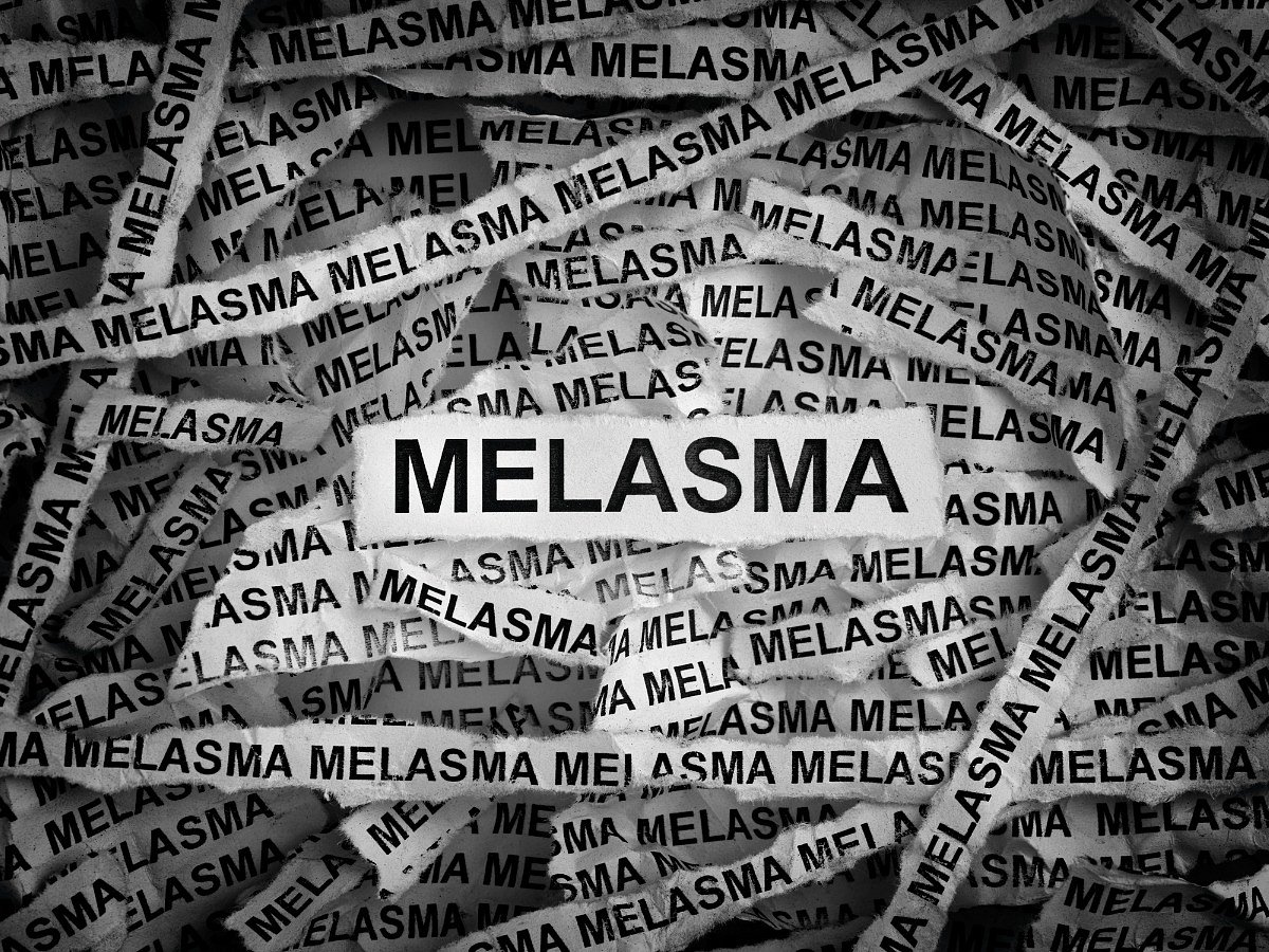 <div class="paragraphs"><p>Here are a few home remedies to treat melasma.</p></div>