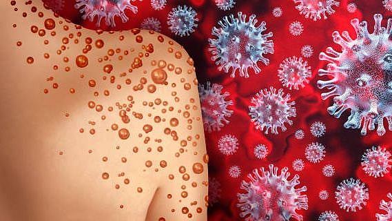 <div class="paragraphs"><p>About 1000 cases of Monkeypox have been recorded from around the world since May 2022.&nbsp;</p></div>