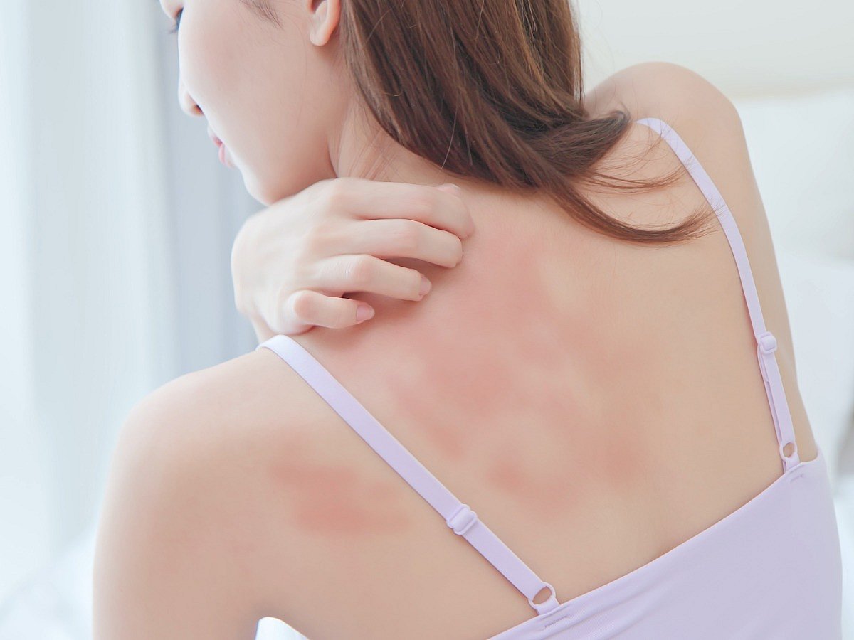 <div class="paragraphs"><p>Know the causes, symptoms, diagnosis, and treatment of dermatitis.</p></div>