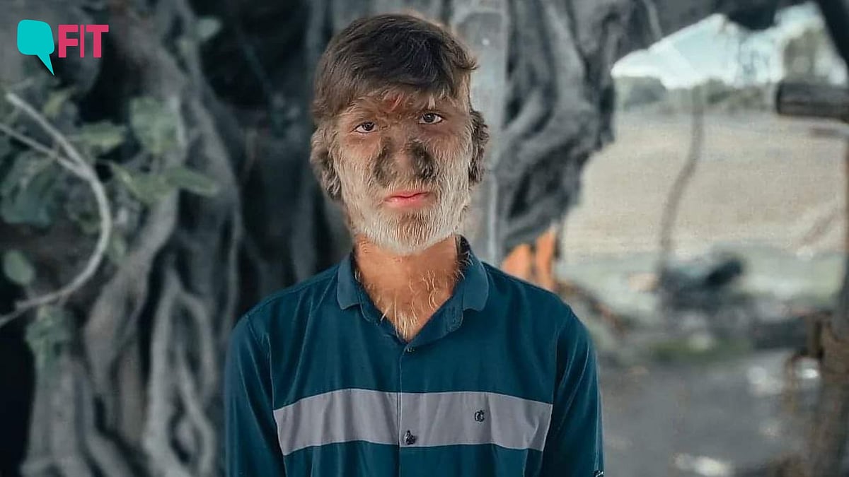 <div class="paragraphs"><p>'Werewolf Syndrome': Lalit Patidar has a rare condition that causes him to have excessive body hair.</p></div>