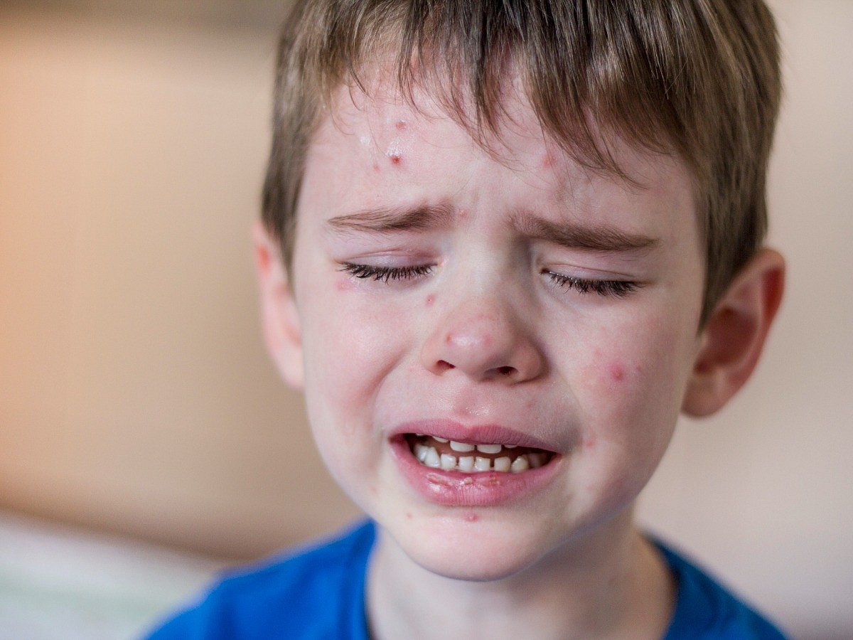 <div class="paragraphs"><p>know the causes, symptoms, diagnosis and treatment of measles infection</p></div>