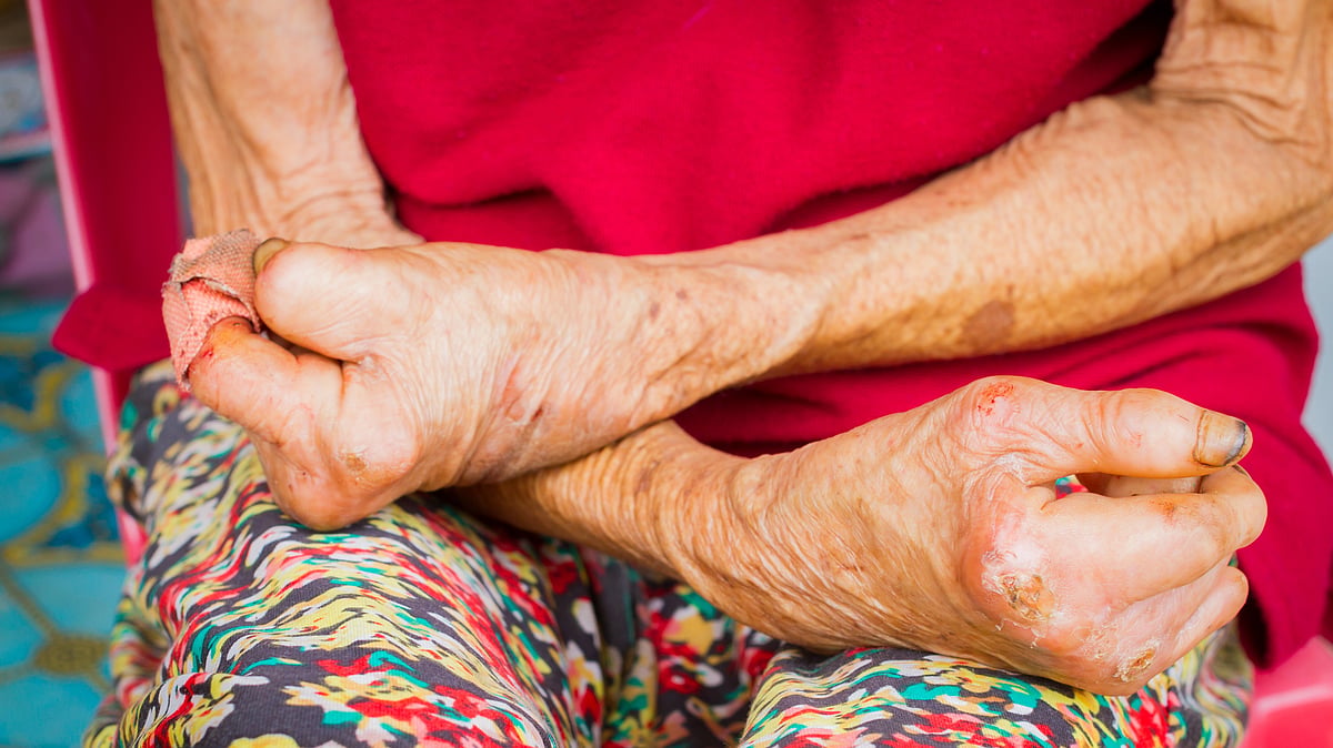 <div class="paragraphs"><p>World Leprosy Eradication Day 2023 theme is "Act Now. End Leprosy."</p></div>