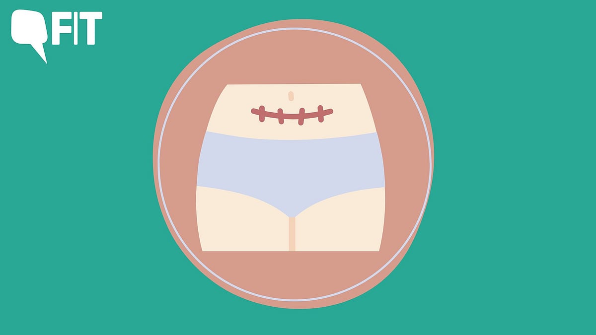 <div class="paragraphs"><p>Hysterectomy - a surgery that might not be quite encouraged societally but when the situation demands, we have to broaden our horizons.</p></div>