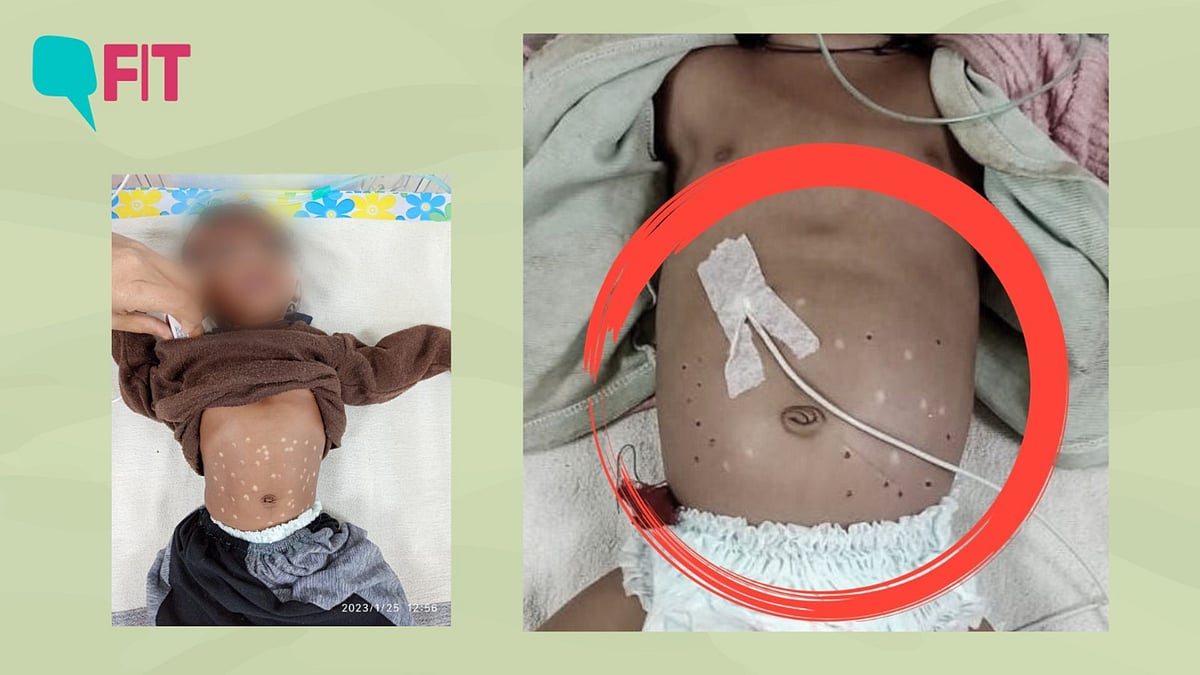 <div class="paragraphs"><p>While brutal, the infant’s death wasn’t the first such case in recent times. In fact, a two-and-a-half-month-old newborn, also suffering from pneumonia, had succumbed to alternate treatment in Madhya Pradesh’s Shahdol just last week.</p></div>