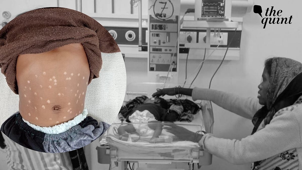 <div class="paragraphs"><p>The woman believed that rubbing the infant's belly with a hot iron rod would cure pneumonia.</p></div>