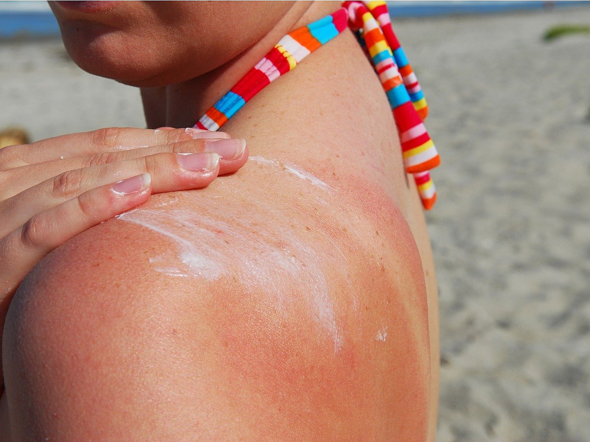 <div class="paragraphs"><p>tips for healing sunburn</p></div>