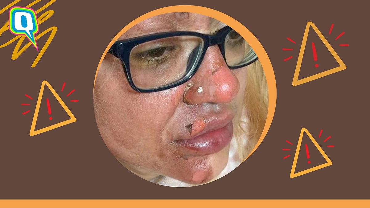 <div class="paragraphs"><p>Woman's Face Peels After Following Viral 'Poached Egg In Microwave' TikTok Hack </p></div>