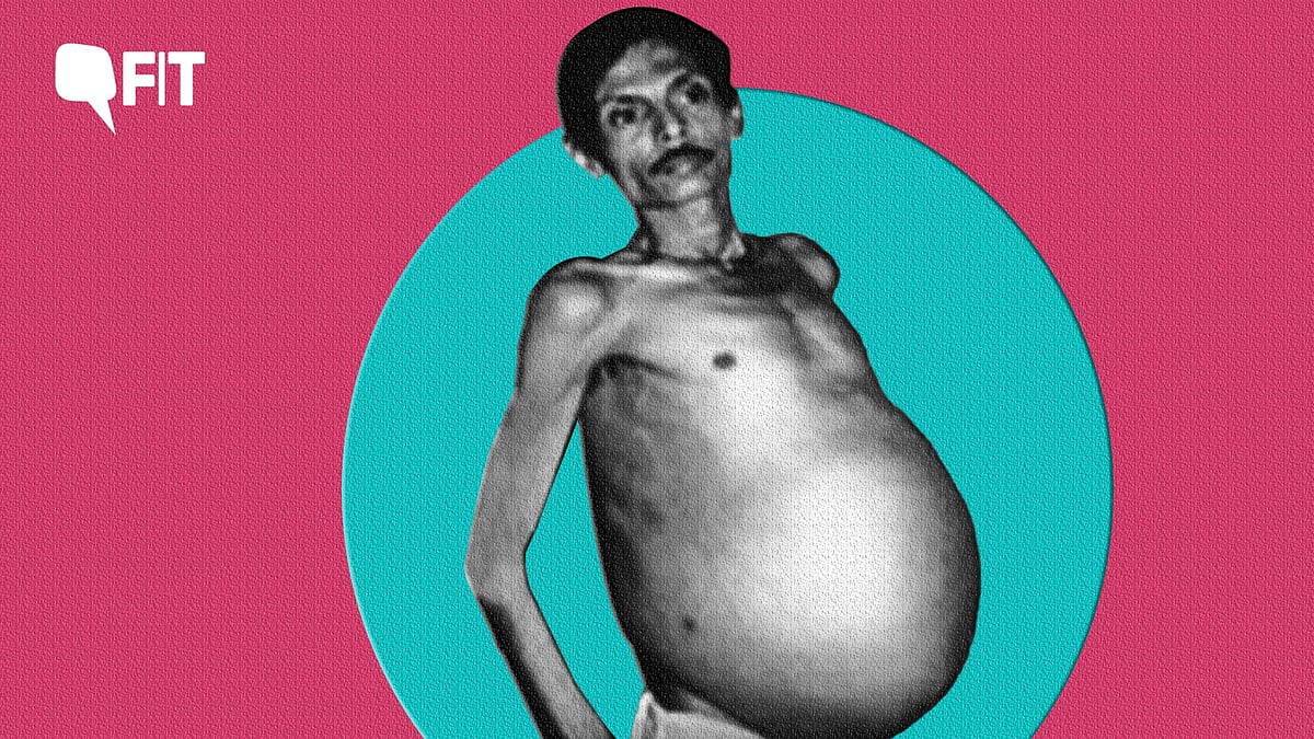 <div class="paragraphs"><p>How could a man be pregnant? And that too for 36 years? <a href="https://www.thequint.com/gender/united-states-walgreens-not-to-dispense-abortion-pills-netizens-react">We decode.</a></p></div>