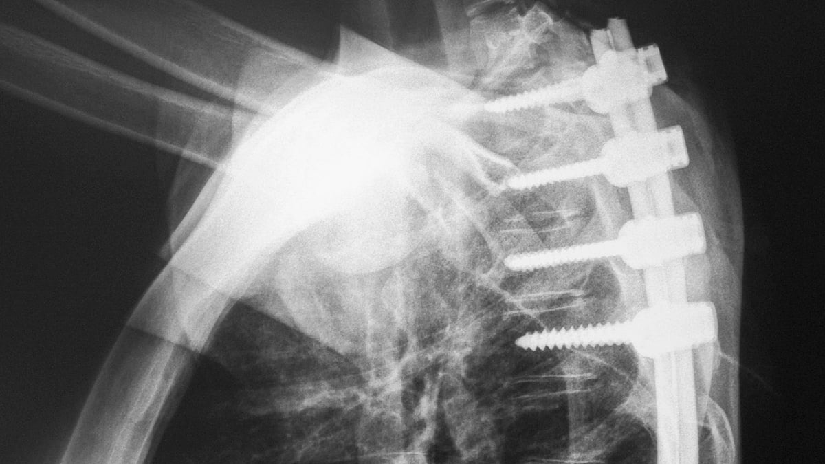 <div class="paragraphs"><p>Orthopedic implants are crucial for knee replacement surgery, fixing bone fractures and other body deformities.&nbsp;</p></div>