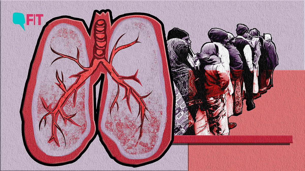<div class="paragraphs"><p>TB drug shortage in India.</p></div>