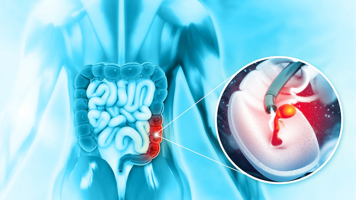 <div class="paragraphs"><p>A blood test can help in early detection of colon cancer.</p><p>(This image is only for representational purposes)</p></div>