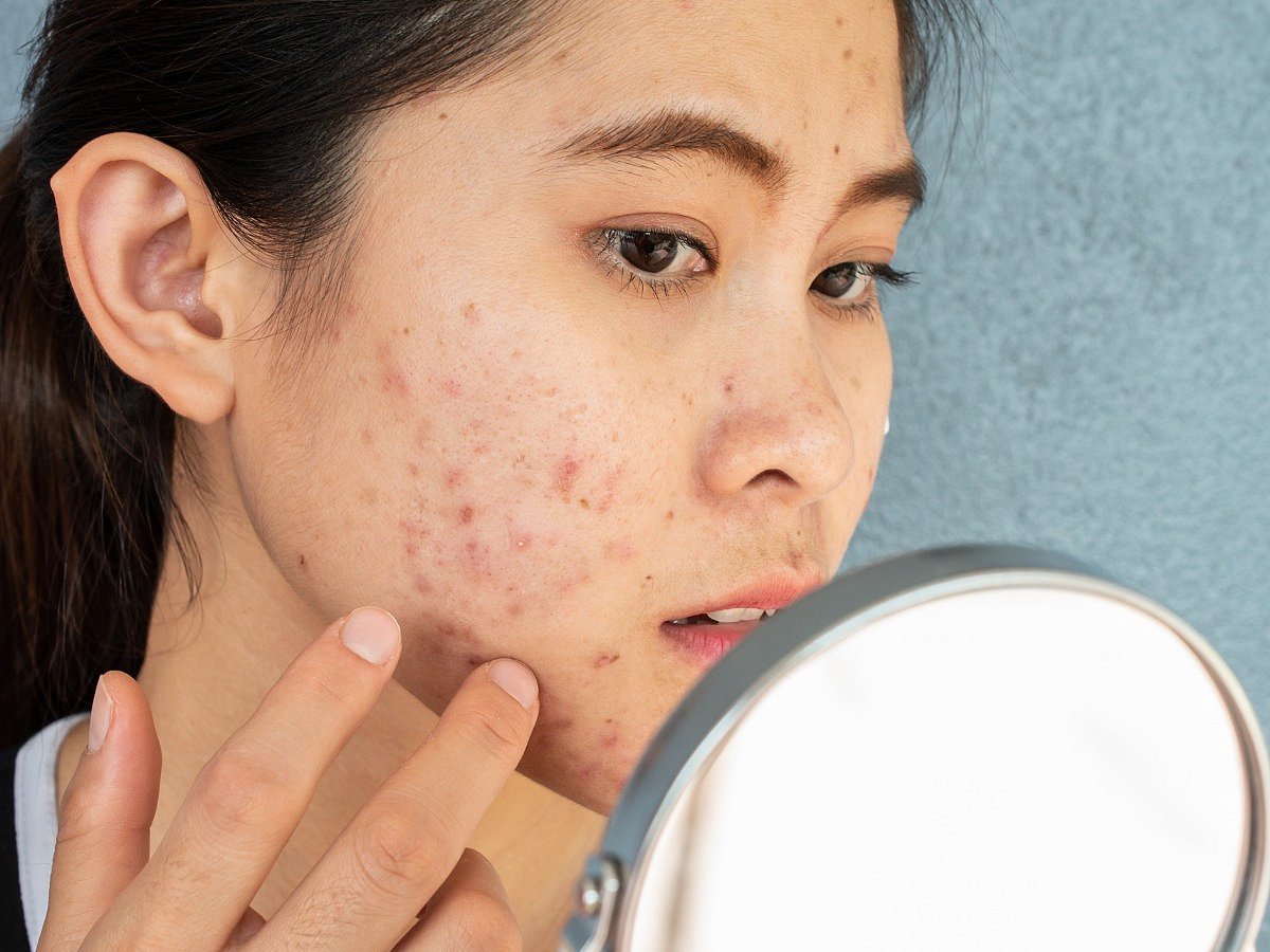 <div class="paragraphs"><p>acne tips </p></div>