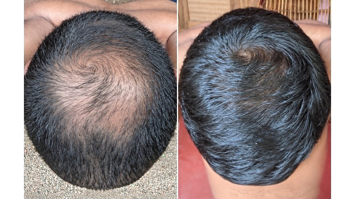 <div class="paragraphs"><p>Minoxidil for hair growth.</p></div>