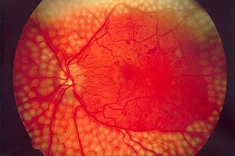 Google's new AI model to help detect diabetic retinopathy