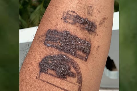 Photo of the smudged ink on Madhu Yaskhi's hand