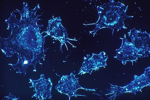 Explainer: Early diagnosis is a must to treat cervical cancer