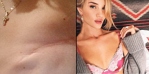 Angry at #showyourbrastrap campaign, breast cancer survivors instead show scars