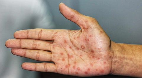 Syphilis