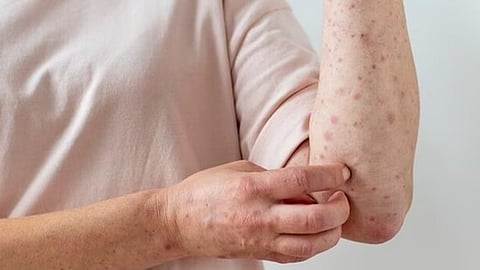 Skin infections in HIV/AIDS patients can be caused by bacteria, fungus, virus and other germ or the treatment they are getting to manage the condition. 